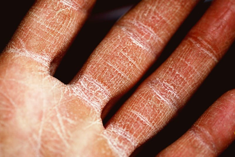 Soothe your skin with natural remedies for eczema