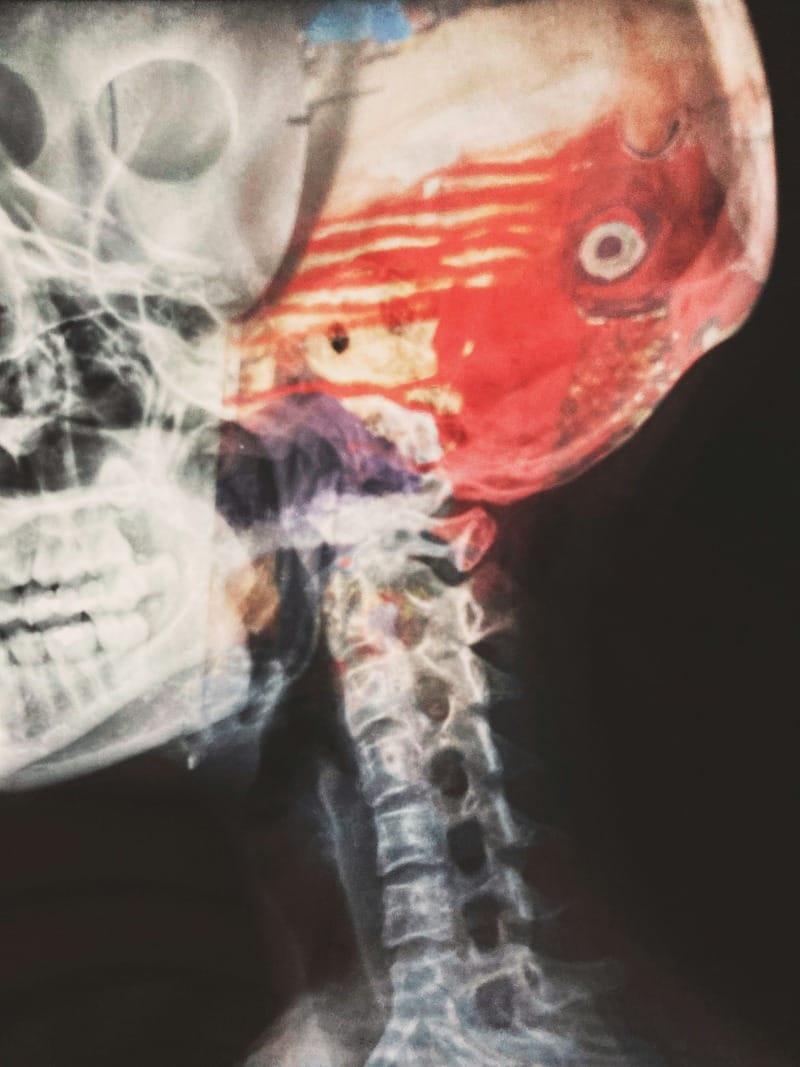 Unraveling the diabetes-dementia link: New studies shed light on brain health